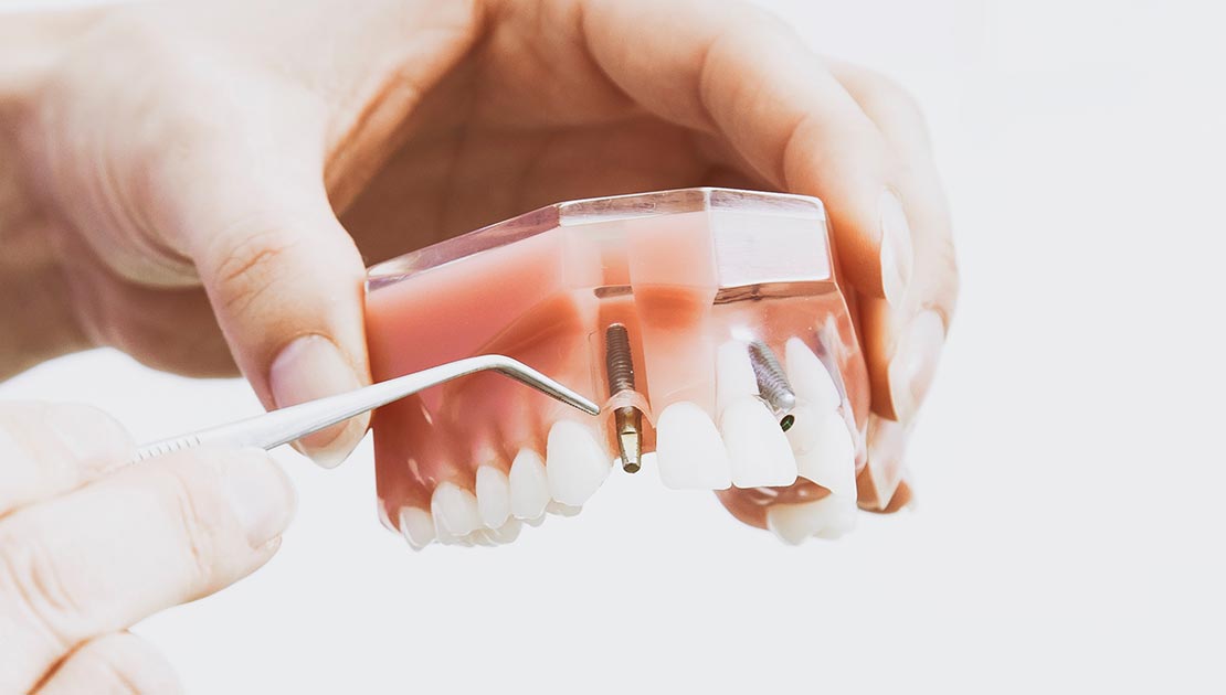 dental-Implant-abu-dhabi